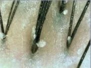 毛穴が詰まっている頭皮